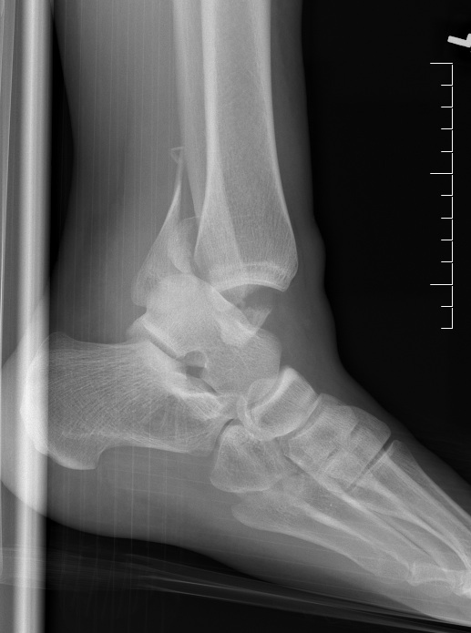 Dislocated Ankle